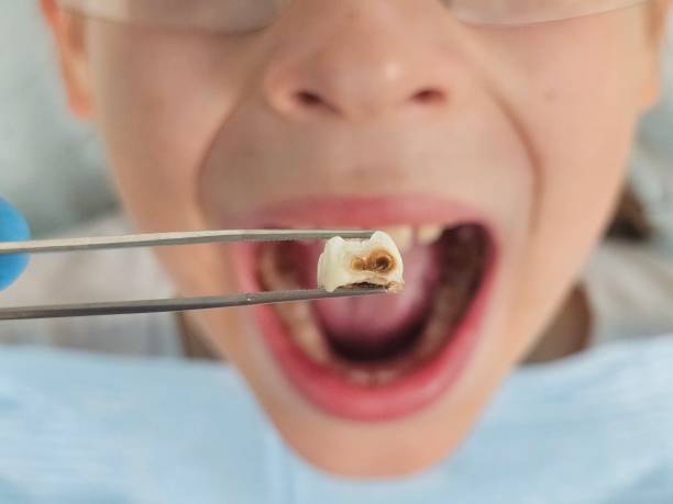 Best Emergency Tooth Extraction  in Fort Morgan, CO